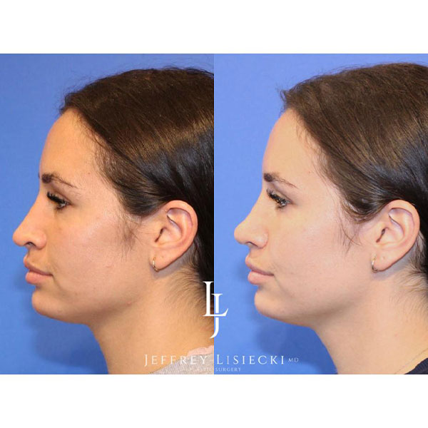 1-left-side-revision-rhinoplasty-4mo-pre-post