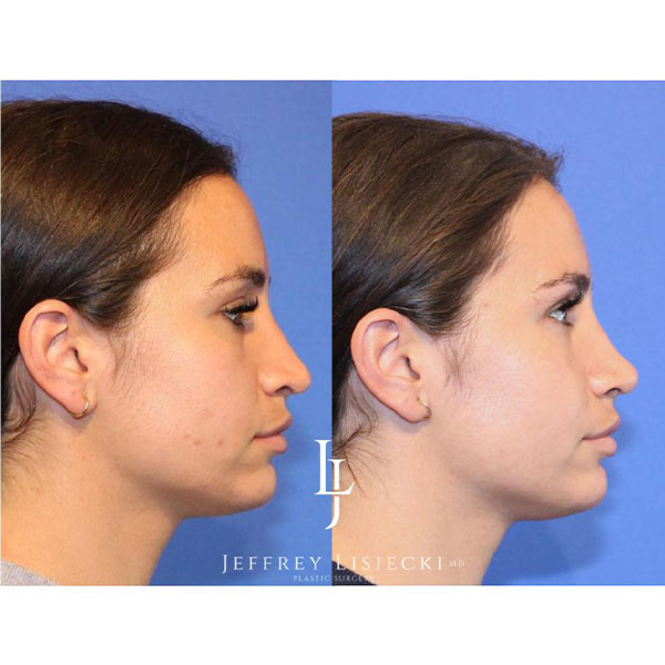 2-lateral-right-1-left-side-revision-rhinoplasty-4mo-pre-post