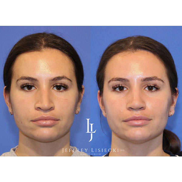 3-front-revision-rhinoplasty-4mo-pre-post