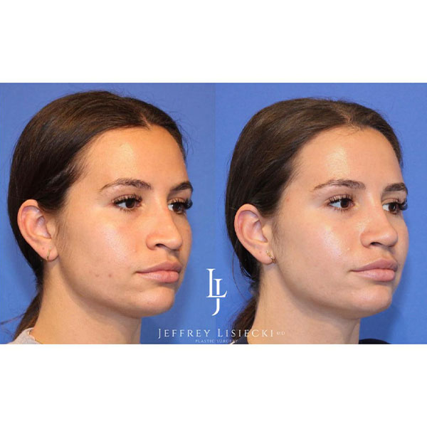 4-lateral-right-revision-rhinoplasty-4mo-pre-post