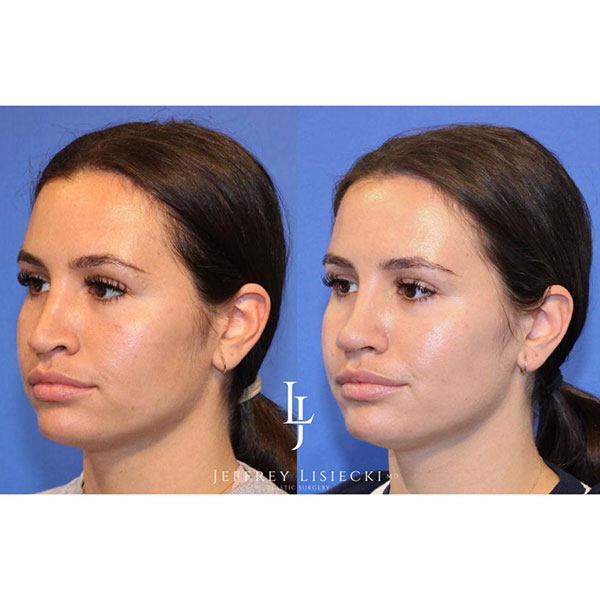 5-lateral-left-revision-rhinoplasty-4mo-pre-post