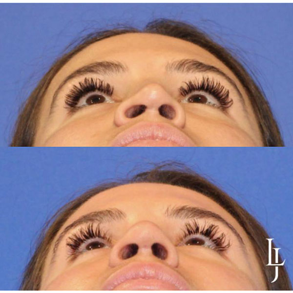 6-chin-view-revision-rhinoplasty-4mo-pre-post