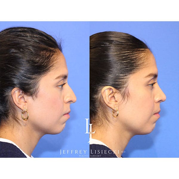 rhinoplasty-21a