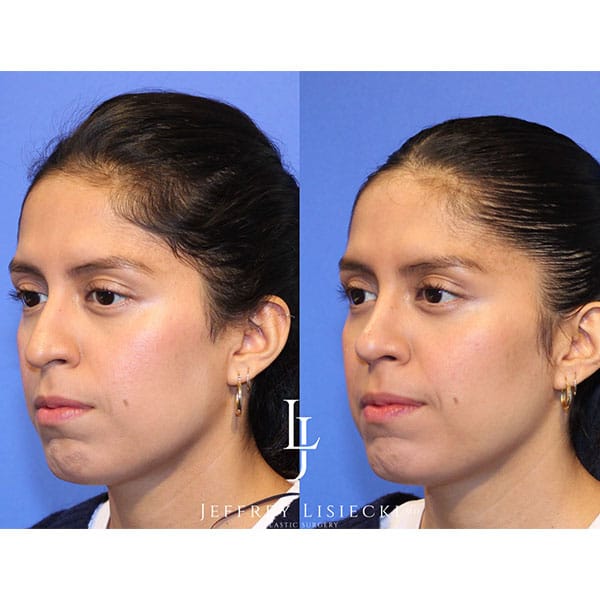 rhinoplasty-21b