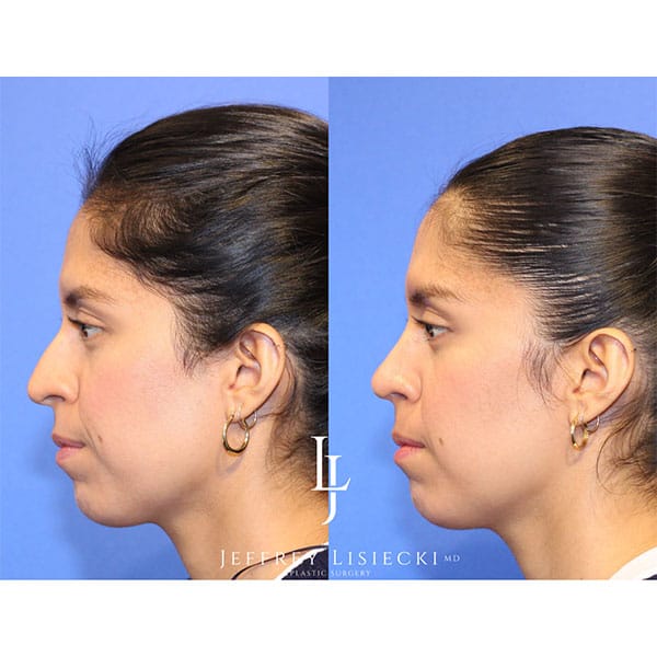 rhinoplasty-21c