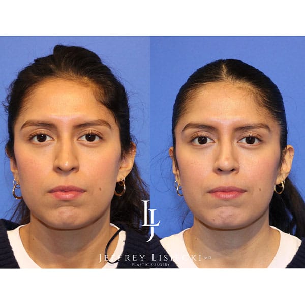 rhinoplasty-21d