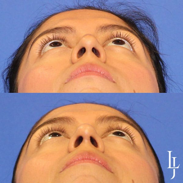 rhinoplasty-21e