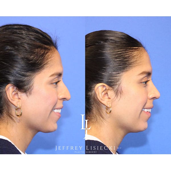 rhinoplasty-21f
