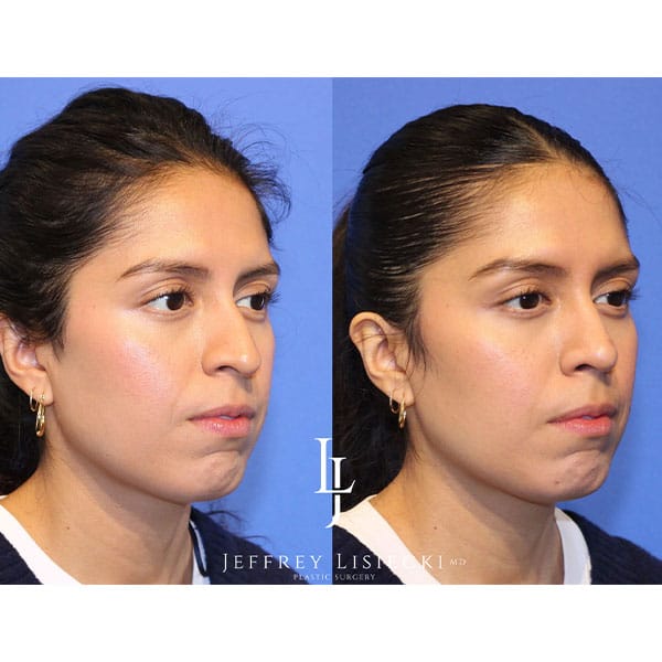 rhinoplasty-21g