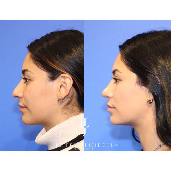 rhinoplasty-22a