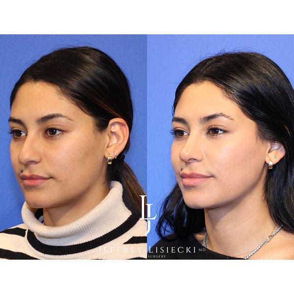 rhinoplasty-22b