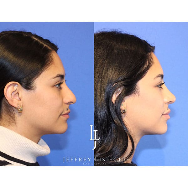 rhinoplasty-22c