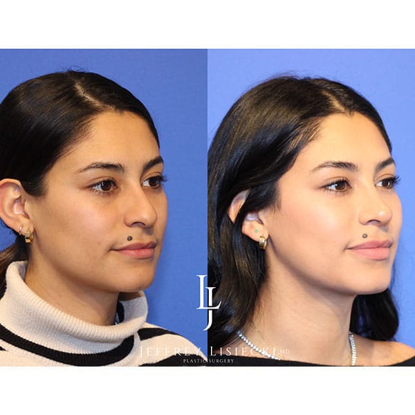 rhinoplasty-22d