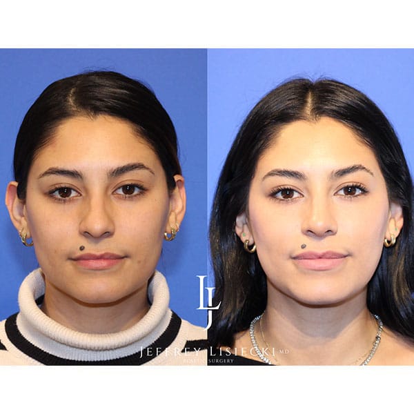 rhinoplasty-22e