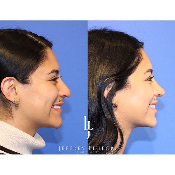 rhinoplasty-22f