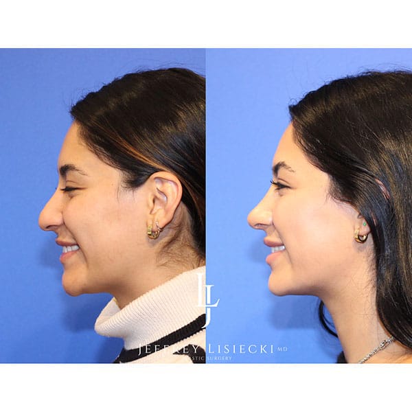 rhinoplasty-22g