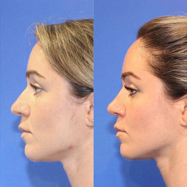 Before and after image of a functional rhinoplasty on a female patient in NYC.