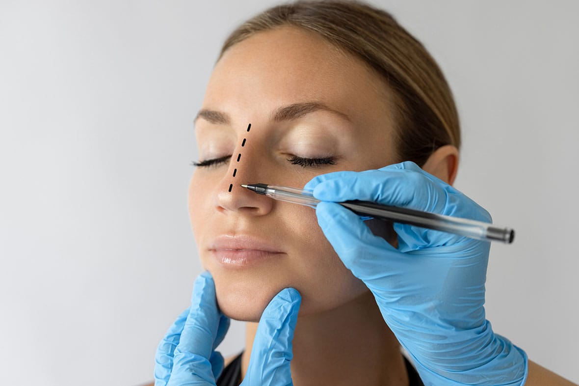 woman before her functional rhinoplasty in NYC
